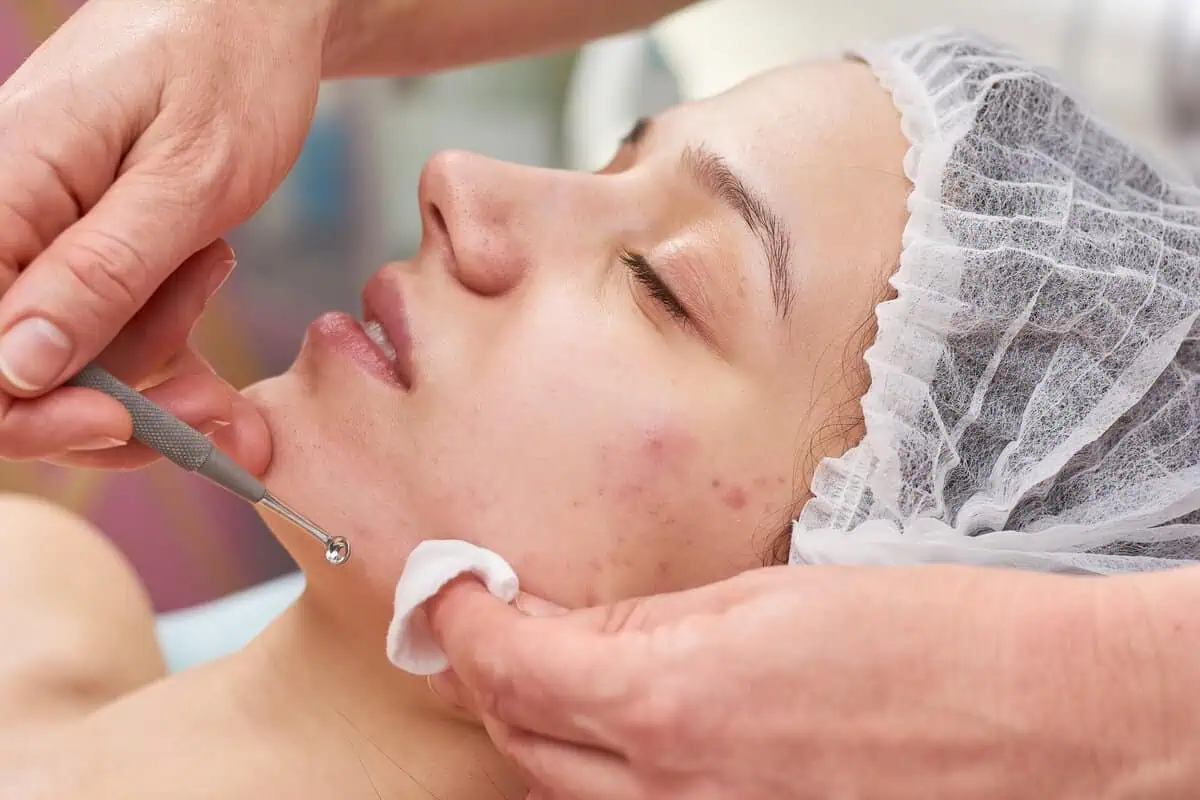 Acne Treatment in Karachi